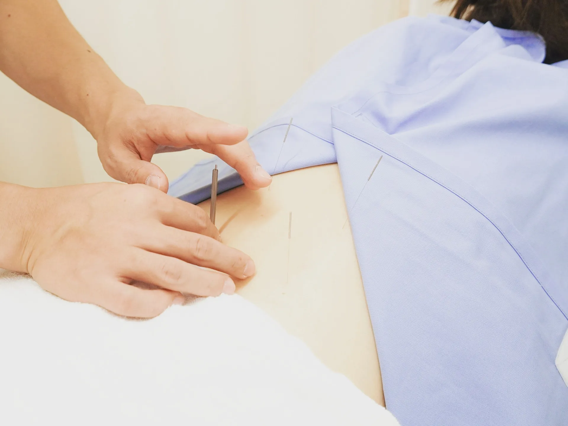 腰痛やぎっくり腰に効く稲荷町駅の鍼灸治療の実際