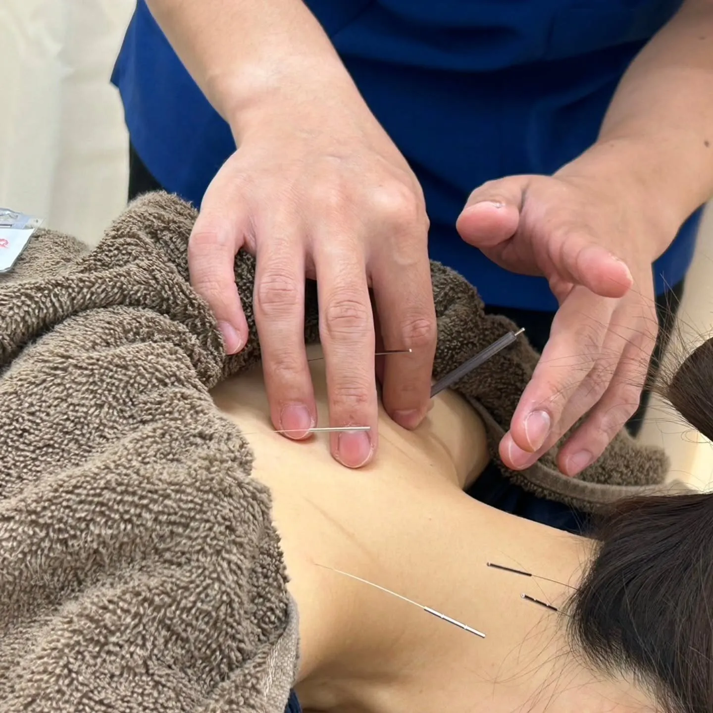 稲荷町駅で首・肩こりの頭痛を解消する鍼灸の根本改善アプローチ