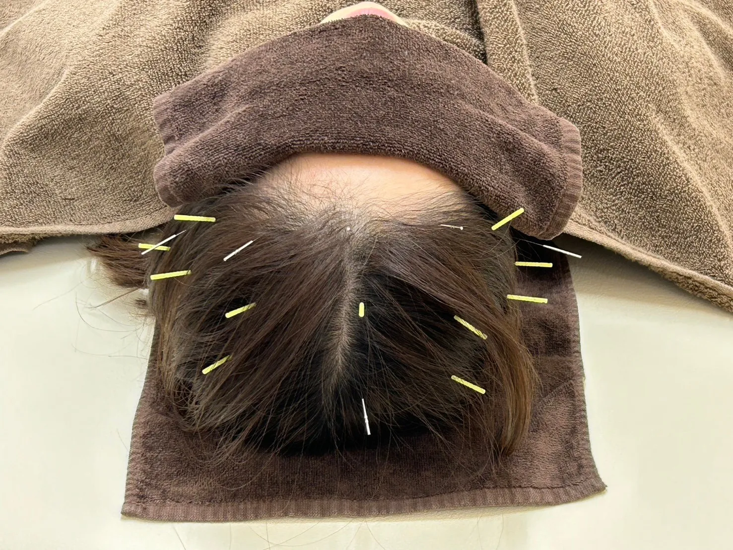 東京都台東区で頭皮鍼を活用し自律神経を整えて睡眠の質を高める実践法