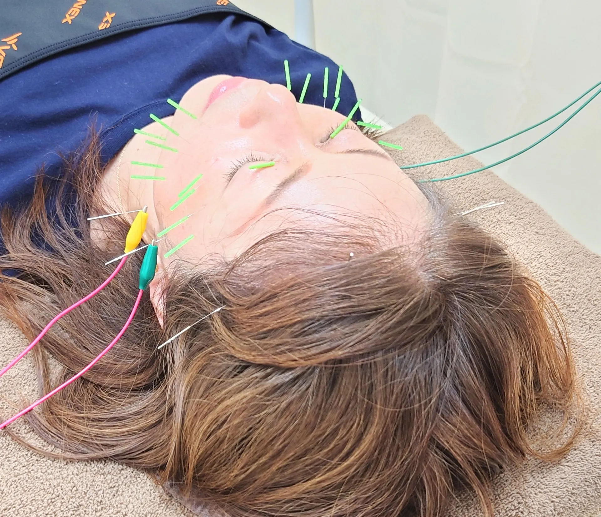 美容鍼でたるみ改善！上野駅周辺のおすすめ施術