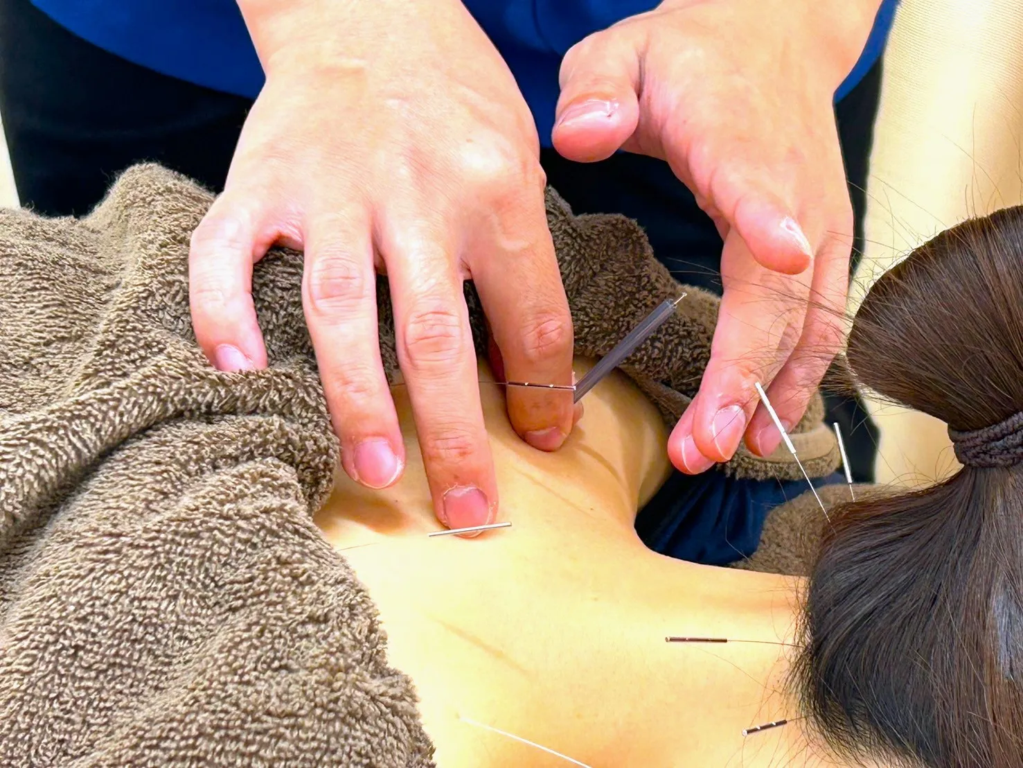 【慢性肩こりに鍼灸×整体】