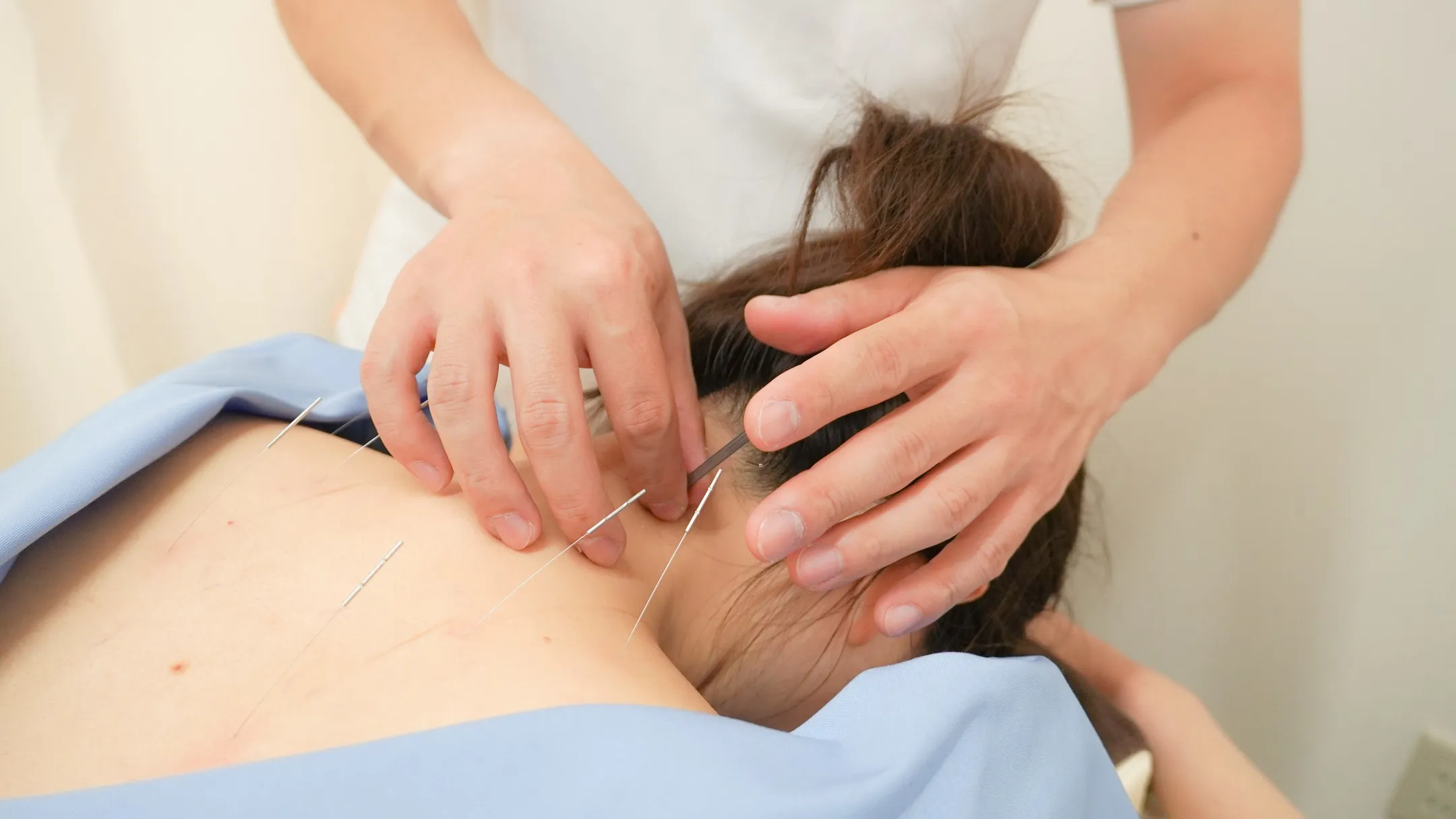 【ボトックスに頼らない肩こりケア！鍼灸で見た目もスッキリ改善...